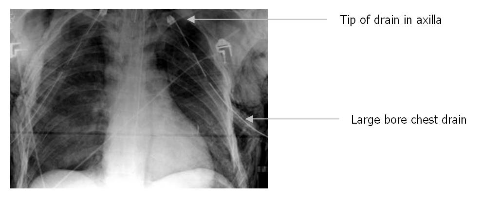 Figure 1 Large bore chest drain on x-ray