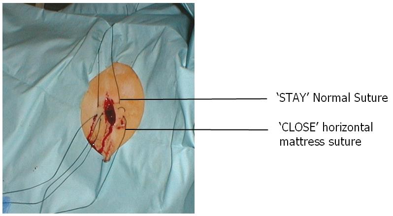 Figure 12 Stay and close sutures