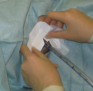 Figure 12 Attaching adhesive dressing