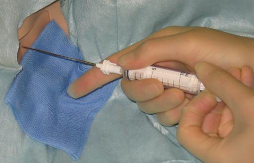 Figure 13 Needle insertion while aspirating